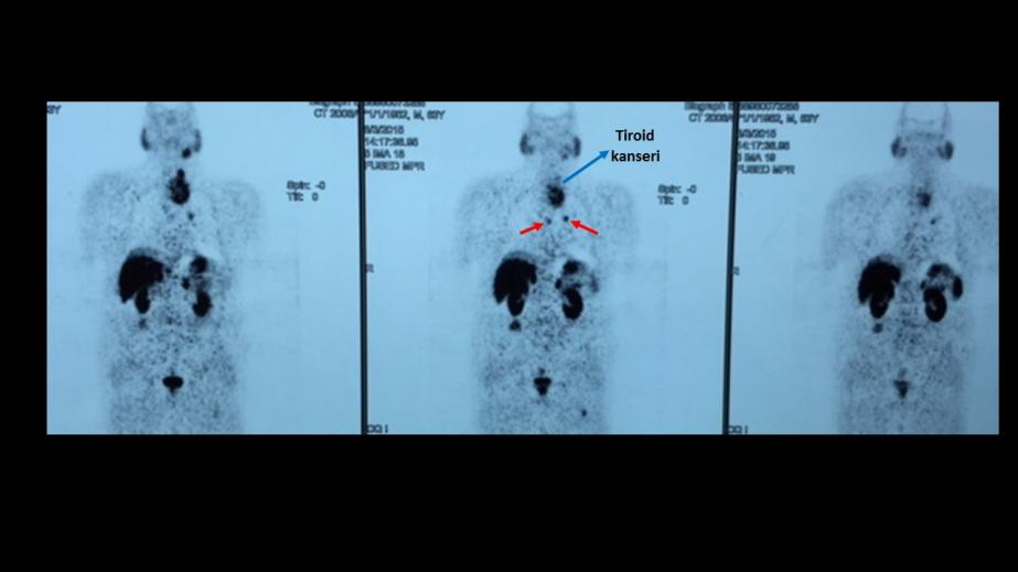 Tiroid kanserine bağlı akciğer metastazı (PET)
