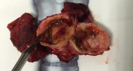 Kistik tiroid nodülünün kist duvarından gelişmiş papiller kanser