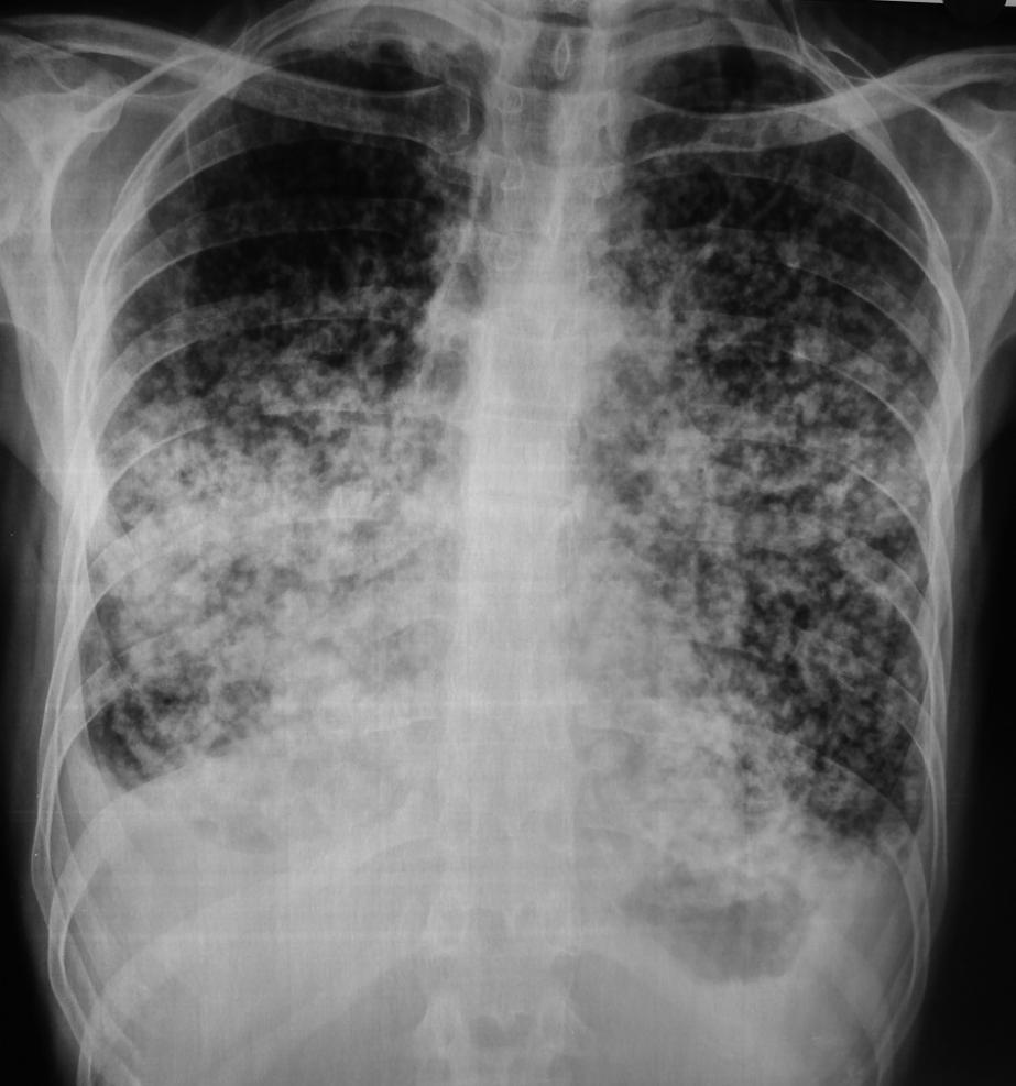 Papiller kanserin akciğer metastazının tipik görünümü