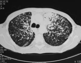 Papiller kanserin akciğer metastazının tipik görünümü