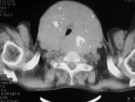 Boyunu simit gibi saran guatr