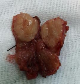 Papiller kanser içeren nodülün kesiti