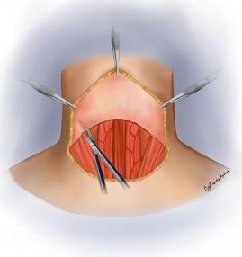 Üst flebin hazırlanması