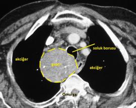 Tomografide göğüsün arka tarafına uzanan iç guatr