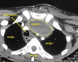 Tomografide göğüsün ön/yan tarafına uzanan iç guatr