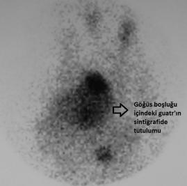 Sintigrafide göğüs boşluğuna uzanan iç guatr