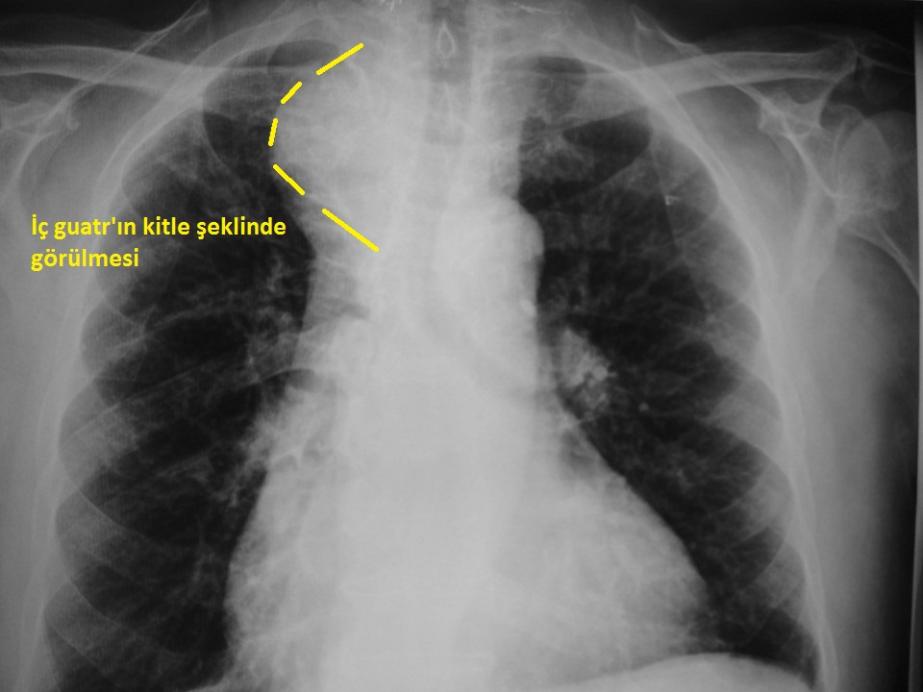 Akciğer grafisinde kitle şeklinde görülen iç guatr