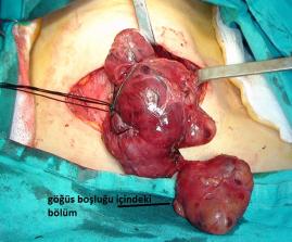 Ameliyatta çıkarılan iç guatr