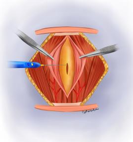 Tiroid lojuna giriş