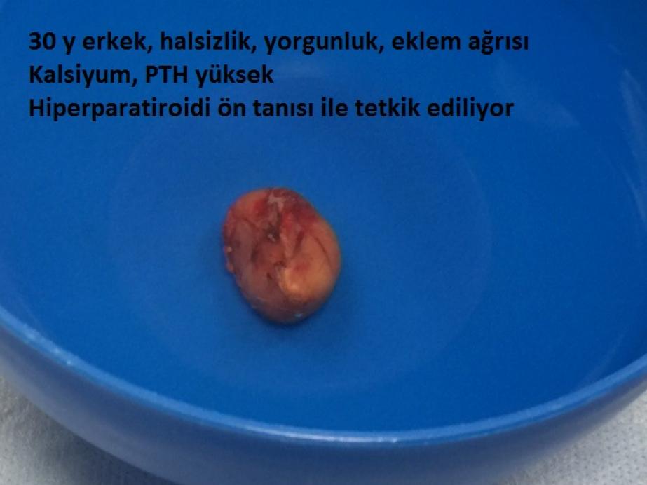 Hiperparatiroidi