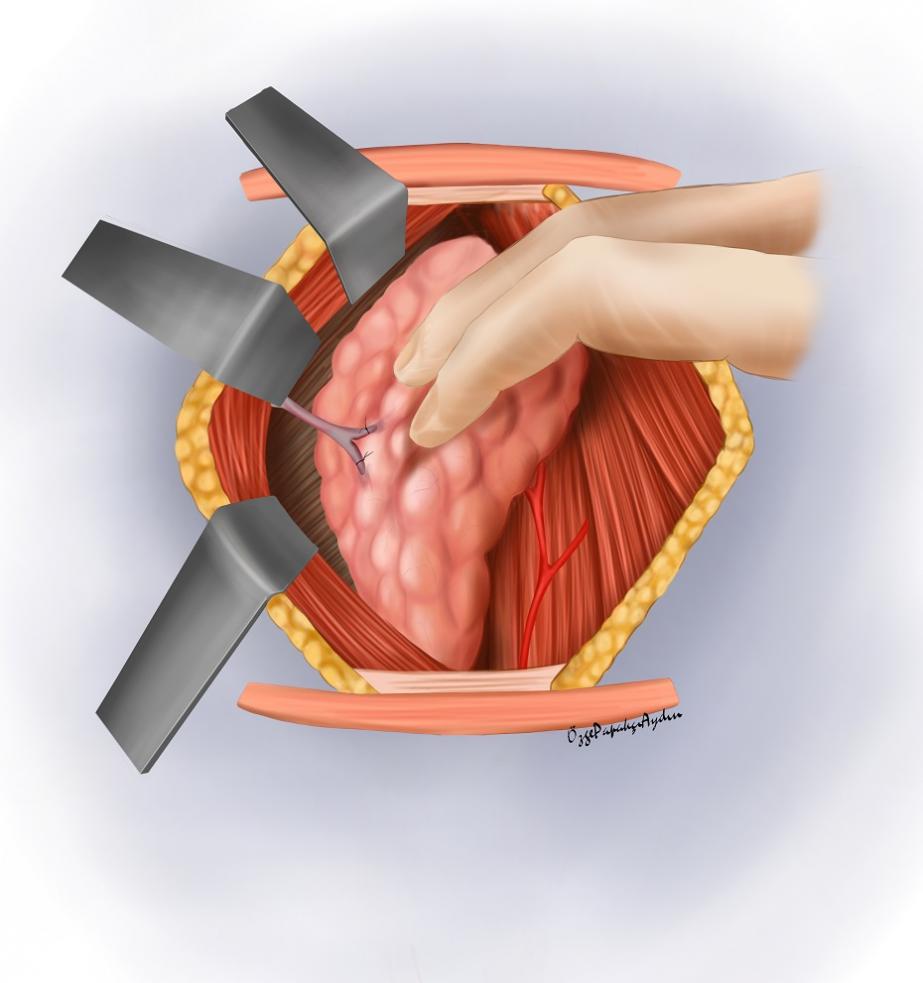Tiroid lobunun dışarıya alınması