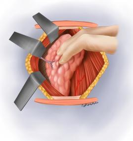 Tiroid lobunun dışarıya alınması