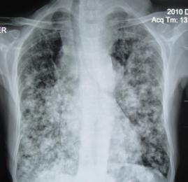 Papiller kanserin akciğer metastazının tipik görünümü