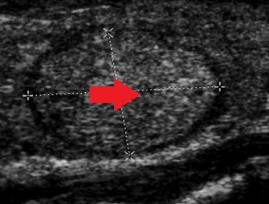 Utrasonografide tiroid nodülleri 
