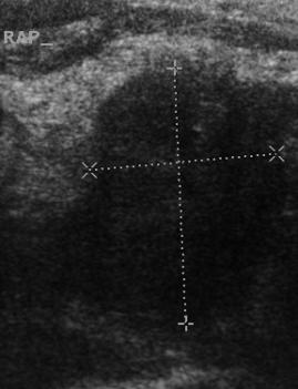 Utrasonografide tiroid nodülleri 