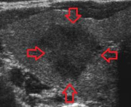 Utrasonografide tiroid nodülleri 