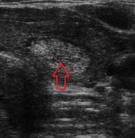 Utrasonografide tiroid nodülleri 
