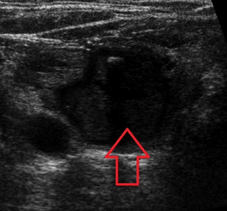 Utrasonografide tiroid nodülleri 