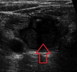 Utrasonografide tiroid nodülleri 