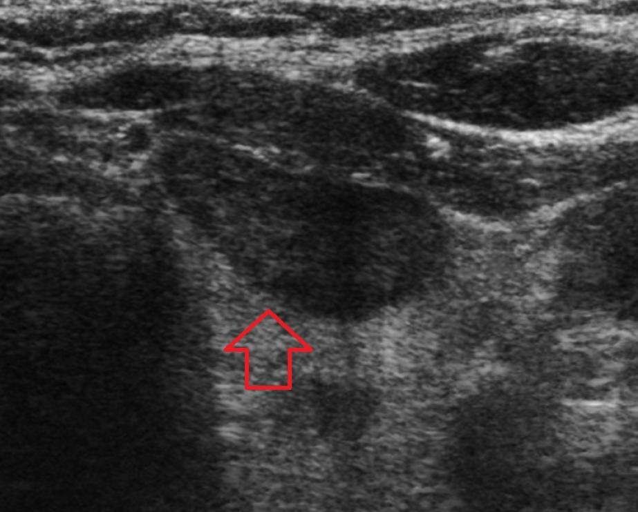Utrasonografide tiroid nodülleri 