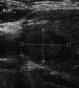 Utrasonografide tiroid nodülleri 