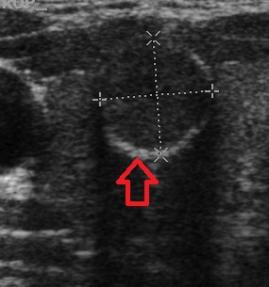 Utrasonografide tiroid nodülleri 