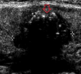 Utrasonografide tiroid nodülleri 