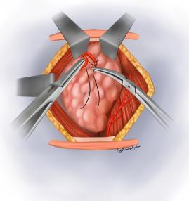 Damarların bağlanması