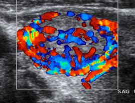 Utrasonografide tiroid nodülleri 