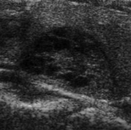 Utrasonografide tiroid nodülleri 