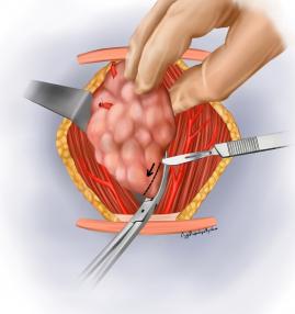 Tiroid lobunun çıkarılması