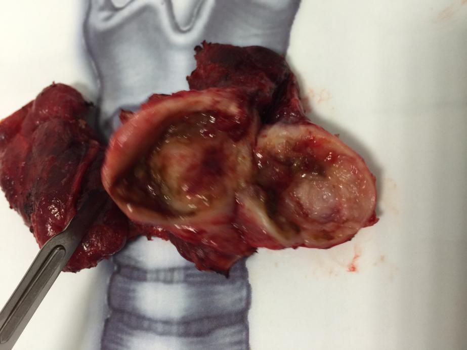 Kistik tiroid nodülünün kist duvarından gelişmiş papiller kanser