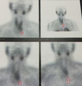 Çok geç tanı konmuş paratiroid adenomu