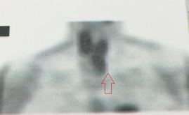 Çok geç tanı konmuş paratiroid adenomu