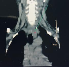 Çok geç tanı konmuş paratiroid adenomu