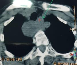 Çok geç tanı konmuş paratiroid adenomu