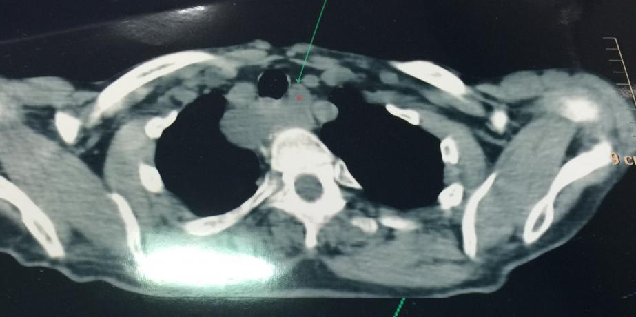 Çok geç tanı konmuş paratiroid adenomu
