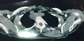 Çok geç tanı konmuş paratiroid adenomu