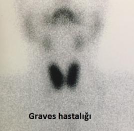 Graves hastalığı
