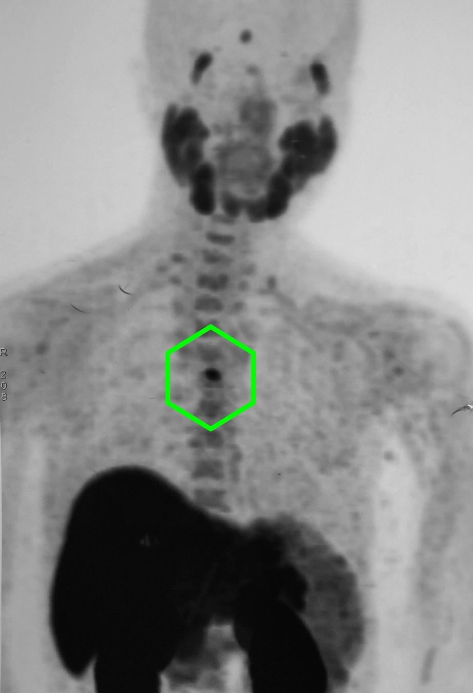 Mediasten yerleşimli (Göğüs içi) paratiroid adenomu