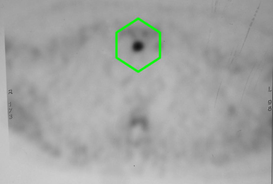 Mediasten yerleşimli (Göğüs içi) paratiroid adenomu