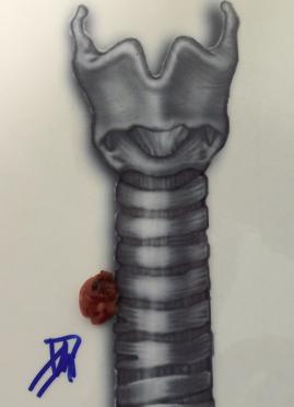 Ameliyatla çıkarılan paratiroid adenomu  (göğüs içine yerleşimli)