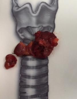 Ameliyatla çıkarılan paratiroid adenomu (tiroidektomi ile birlikte)
