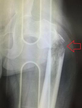 Kemik metastazı olan hastada kemik kırığı 