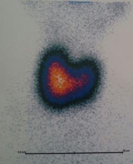 Graves (Zehirli guatr)