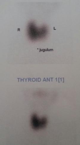 Graves (Zehirli guatr)