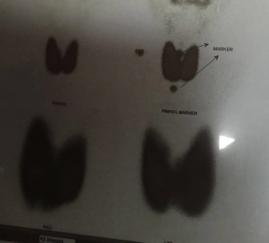 Graves (Zehirli guatr)