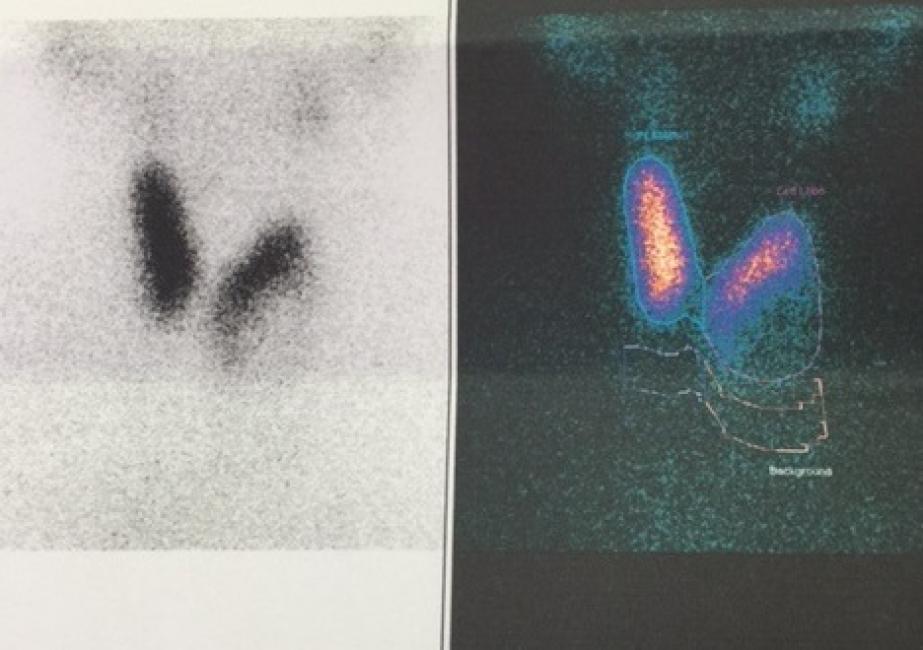 Hipoaktif nodül (Soğuk nodül)