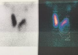 Hipoaktif nodül (Soğuk nodül)