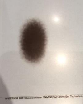 Toksik adenom (Sıcak  nodül)